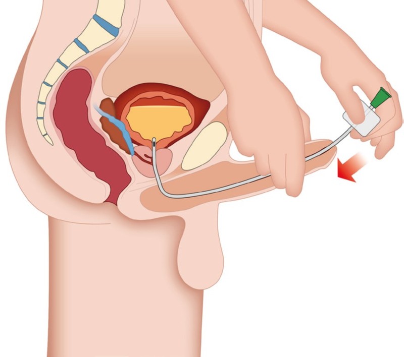 Das Bild zeigt, das Einführen des Katheters unter leichter Streckung des Penis