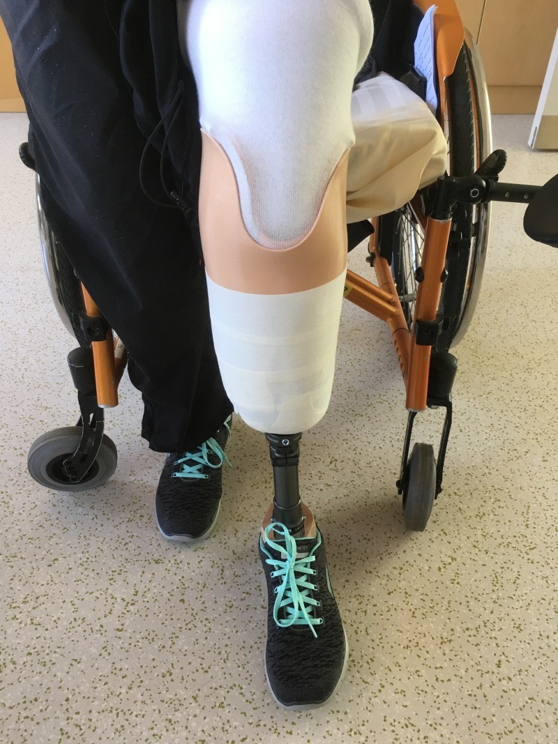 Die Prothese mit Pin-System ist nun angezogen und kann im Alltag im Stehen/Gehen eingesetzt werden.