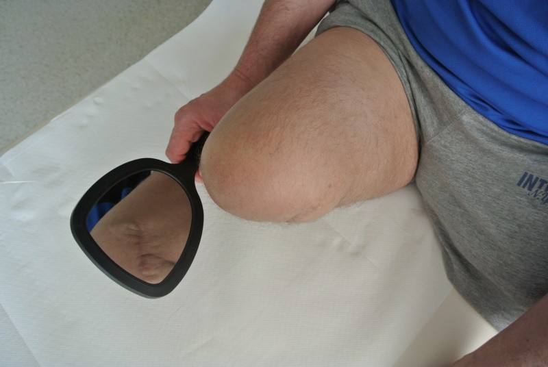 Die Haut auf der Rückseite des Oberschenkelamputationsstumpfes wird mit einem Spiegel auf mögliche Verletzungen kontrolliert.