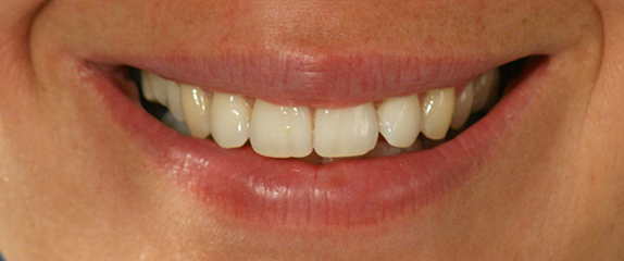 Nahaufnahme eines lächelnden Mundes, bei dem die Zähne zu sehen sind. 
