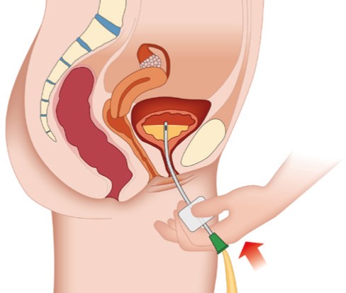 Das Bild zeigt  wie der  Schlauch des Urinbeutels beim Herausziehen des Katheters abgeknickt wird.