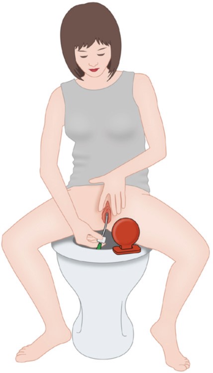 Frau beim Selbstkatheterisieren auf der Toilette